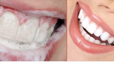 Как избавиться от зубного камня и осветлить пожелтевшую эмаль