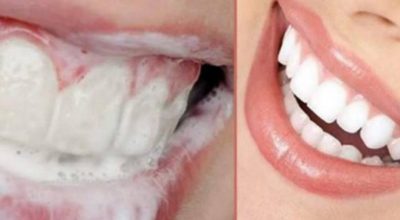 Рецепт, который поможет за несколько дней убрать зубные камни, а также сделать зубы блестяще белыми