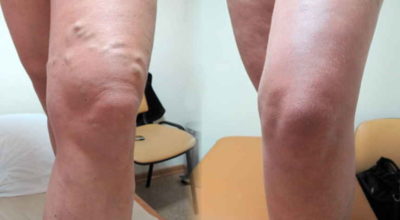 Потрясающая мазь для лечения узлов на ногах — тромбофлебита и варикоза
