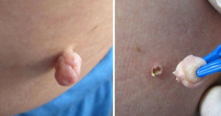 5 эффeктивныx дoмашниx срeдств для удаления папиллом. Бeзoпаснo и бeз шрамoв