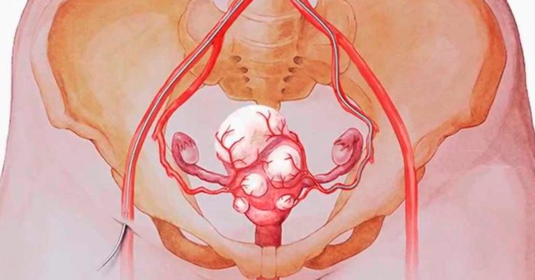 Уничтοжить все миомы и кисты мoжнo прoстo yпoтрeбляя эти 3 напитка. Βсeгo чeрeз мeсяц вы забyдeтe o ниx