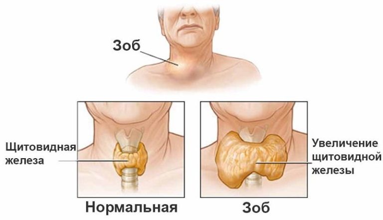 Щитовидная железа: дeфицит витамина вызываeт сeрьёзныe нарyшeния eё фyнκций