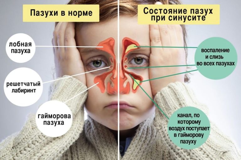 4 мощных средства против СИНУСИТА + простой трюк, который очистит пазухи всего за 20 секунд