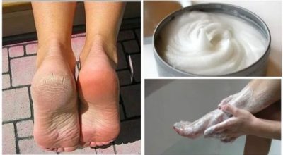 Народное средство для устранения грибков и мозолей на ногах