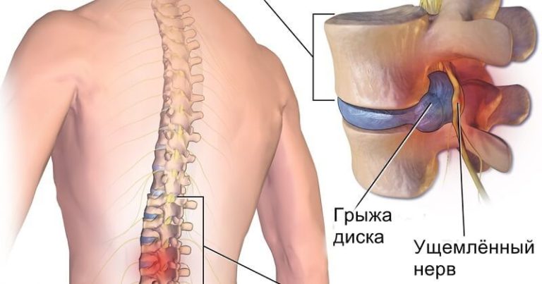 Зарядка, которая поможет справиться с грыжей межпозвоночного диска