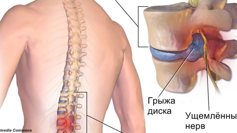 Зарядка, которая поможет справиться с грыжей межпозвоночного диска